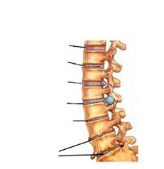 Osteokondroz gelişiminin aşamaları