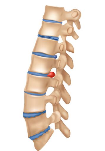 Deophrming osteokondroz nasıl görünüyor