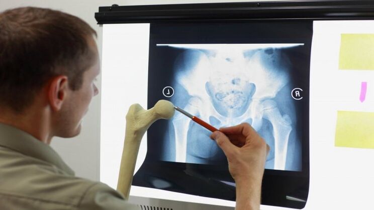 Doktor kalça artrozu için röntgeni inceliyor